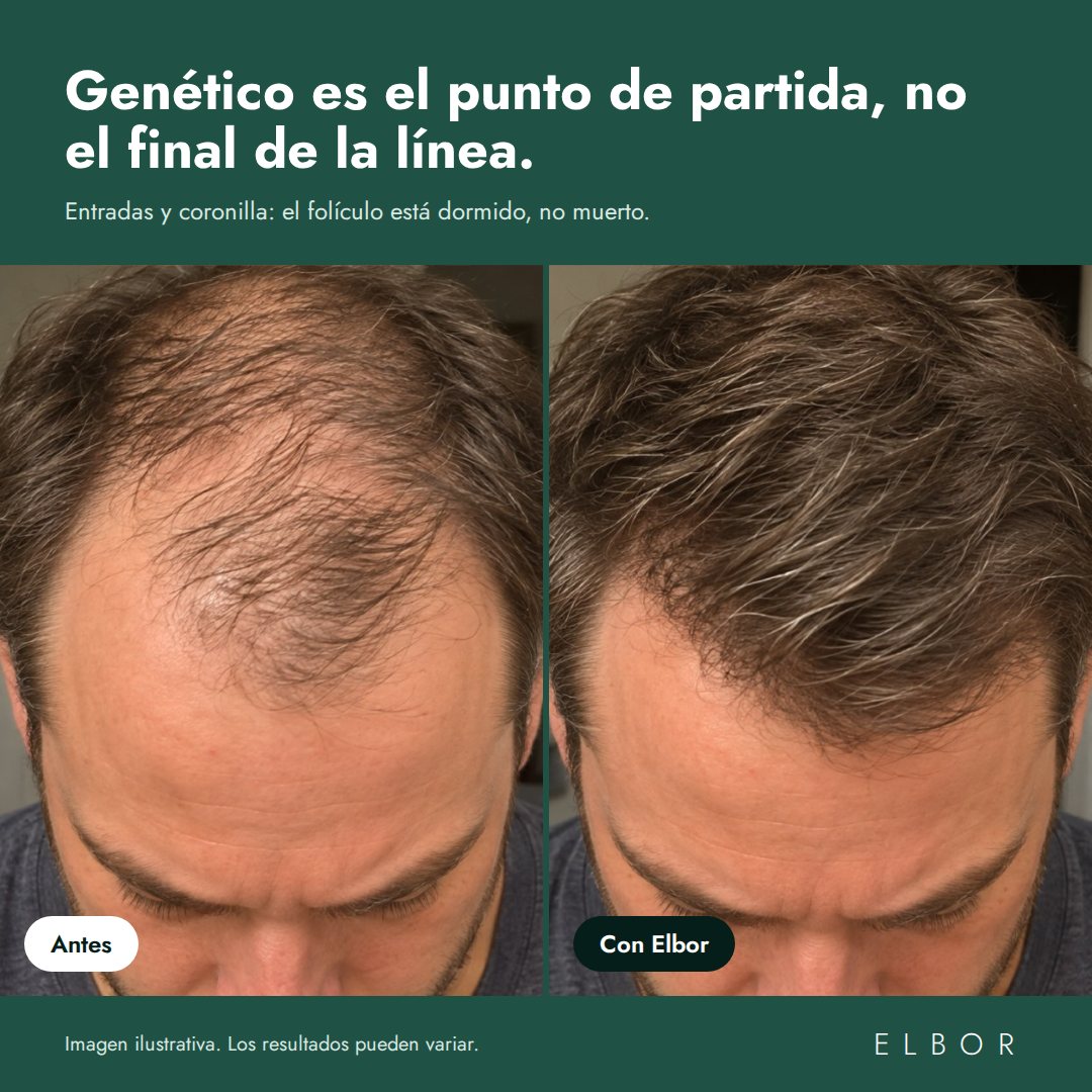 Cabello antes y con Elbor, imagen ilustrativa