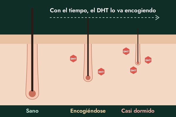 El DHT encoge el folículo
